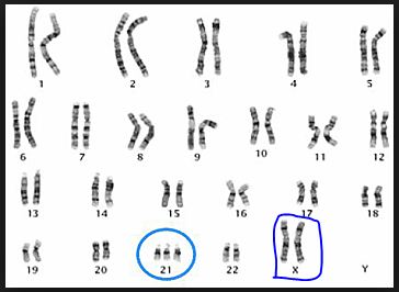 dwarfism karyotype