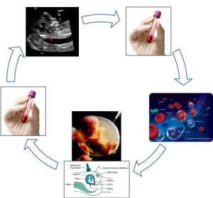 Webinar On Prenatal Testing For Down Syndrome Down Syndrome Prenatal